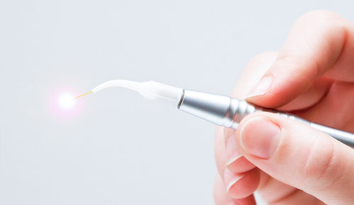 Laser intraorale