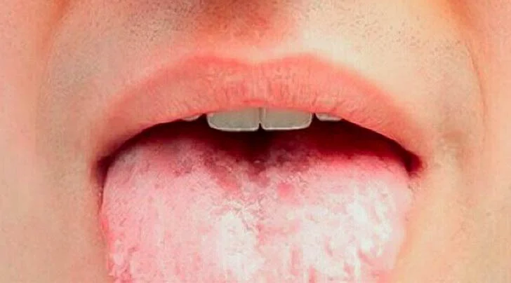 xerostomia e bocca secca