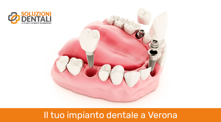 implantologia-dentale-verona