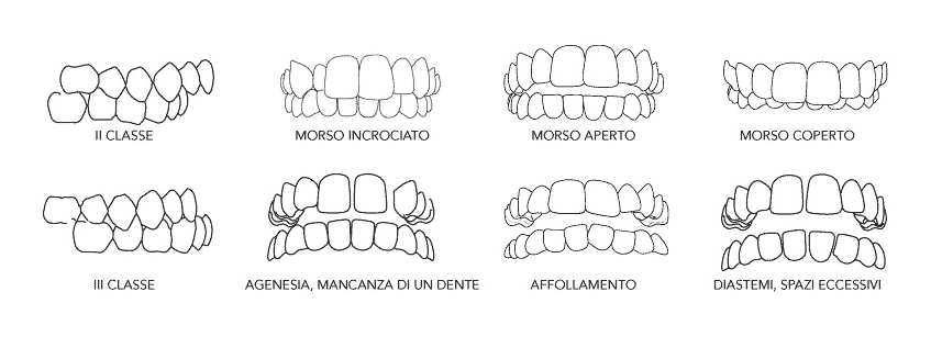malocclusioni dentali 
