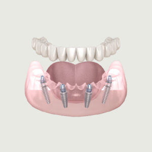 IMPLANTOLOGIA ALL ON FOUR