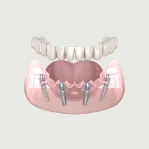IMPLANTOLOGIA ALL ON FOUR
