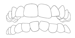Affollamento-dentale
