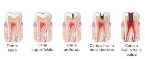Cura carie verona