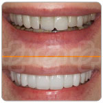 Faccette dentali verona