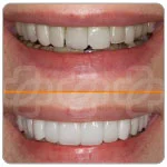 Faccette dentali verona