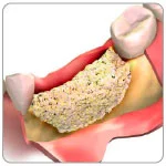 Implantologia-senza-osso