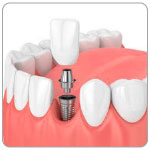 Impianti dentali con protesi fissa
