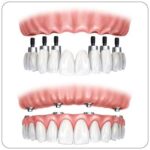 La tecnica All-on-four®