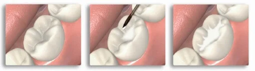 rimozione carie verona