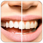 Sbiancamento-dentale-professionale-verona