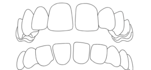Spaziatura-tra-i-denti