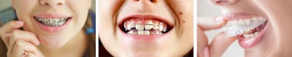 apparecchio per denti bambini