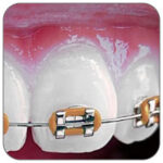 apparecchio-ortodontico-bambini-verona