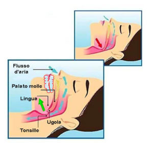 Respirazione con bite antirussamento
