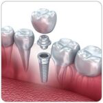 Cos'è l'implantologia a carico immediato