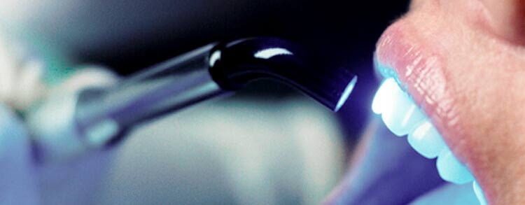 sbiancamento-dentista-verona